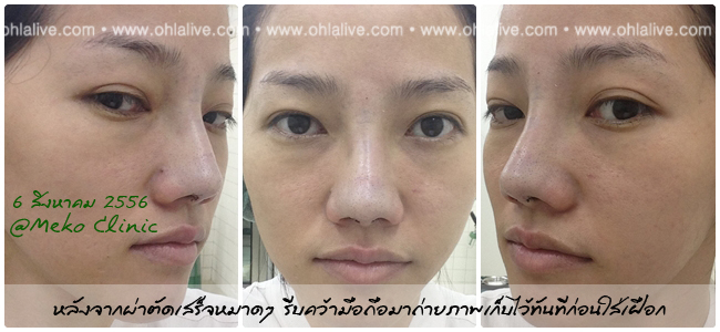 day 0 - right after operation