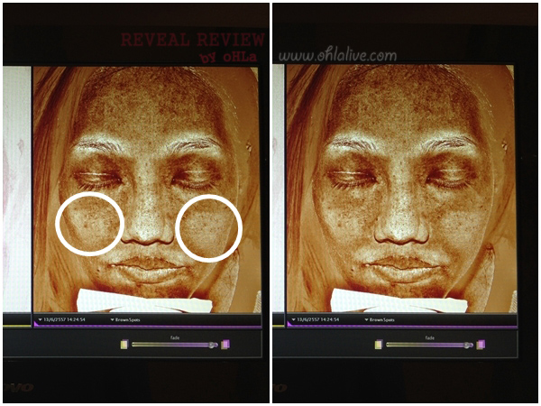 2 ภาพนี้คือภาพเดียวกัน เป็นการตรวจเช็คจุดด่างดำใต้ผิวด้วยเครื่อง reveal ซึ่งบริเวณที่วงกลมไว้ 2 วง นั้นคือบริเวณที่เก๋ทาเจ้า SK-II ออร่านี้แบบขี้เกียจๆช่วงกว่า 2 เดือน คือ ทาๆ แปะๆแบบไม่ทั่วถึง จะเห็นว่าสีผิวใต้ผิวบริเวณวงกลมนั้นดูขาวกว่าบริเวณอื่นๆ