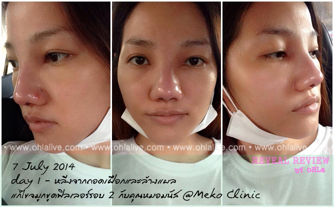 บันทึกเสริมจมูก-mekoclinic-fillerfix2-after-day1