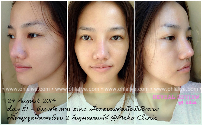 บันทึกเสริมจมูก-mekoclinic-fillerfix2-after-day51