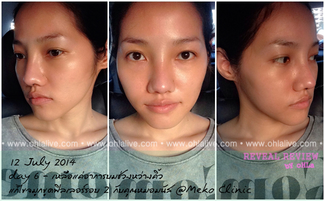 บันทึกเสริมจมูก-mekoclinic-fillerfix2-after-day6