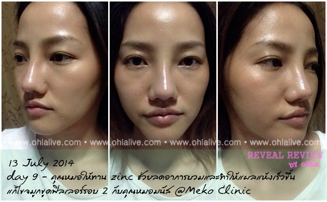 บันทึกเสริมจมูก-mekoclinic-fillerfix2-after-day9