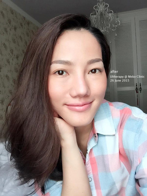 meko-clinic-ulthera-after-26JUN15
