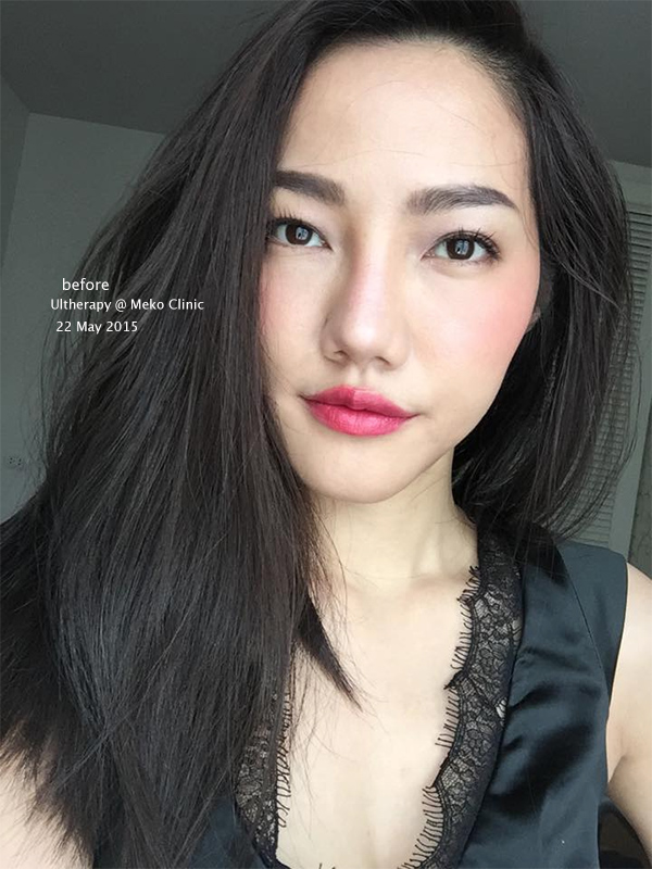 meko-clinic-ulthera-before-22MAY15