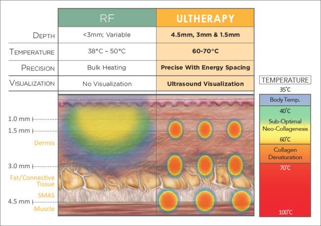 ulthera-diagram-vs-rf