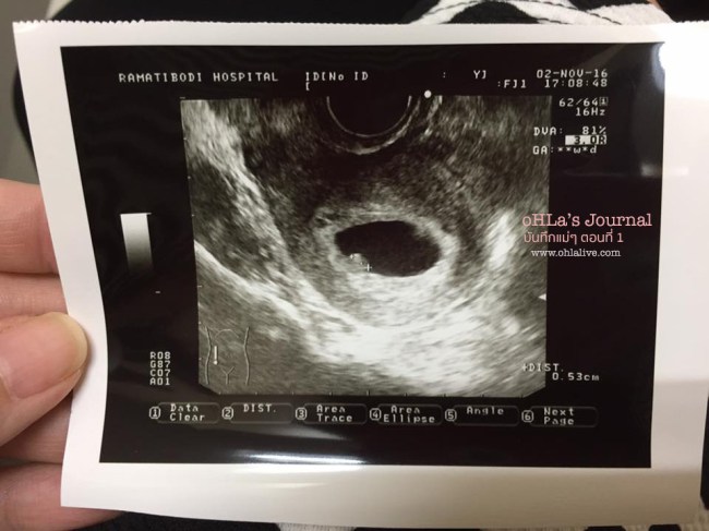 ultrasound-2-nov-16